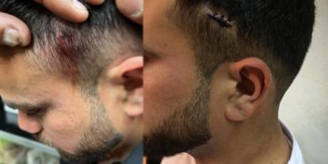 Φασίστας πυροβόλησε στα Πατήσια μουσουλμάνους μετανάστες εργάτες